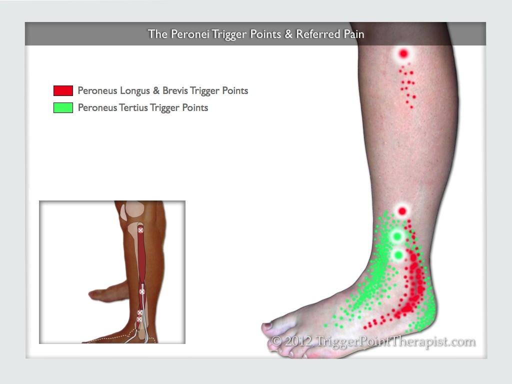 Image of Fibularis Trigger Points and Referred Pain