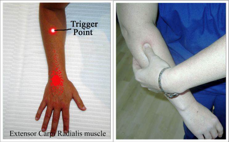Self-Applied-Release-of-the-Extensor-Carpi-Radialis-Trigger-Point.png