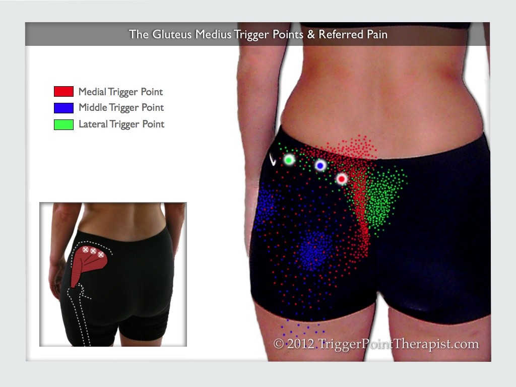 Image of The Gluteus Medius Trigger Points and Referred Pain