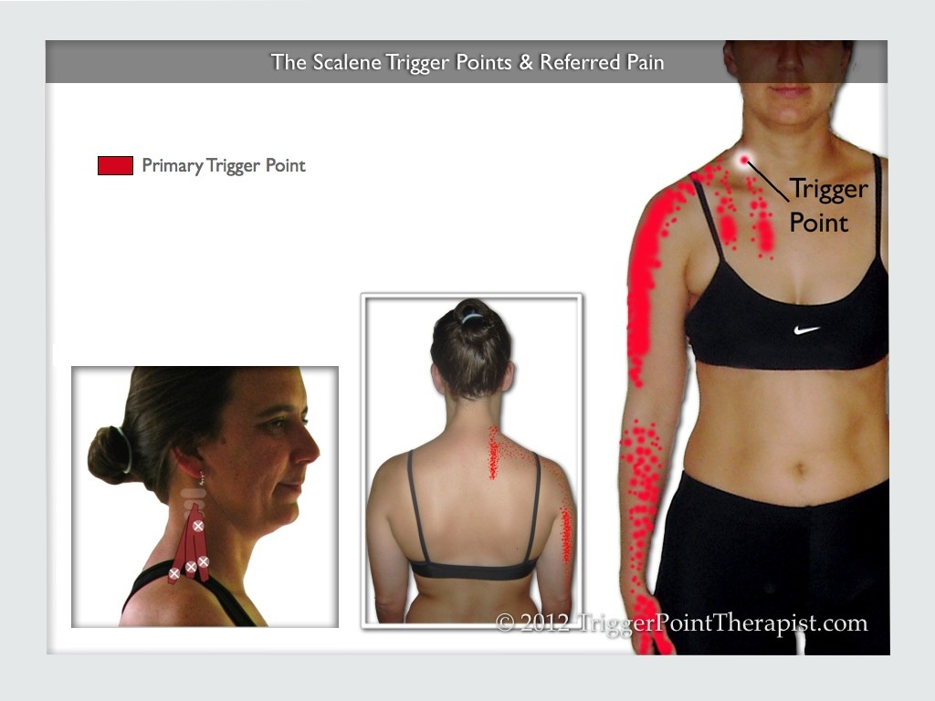 Image of The Scalene Trigger Points & Referred Pain