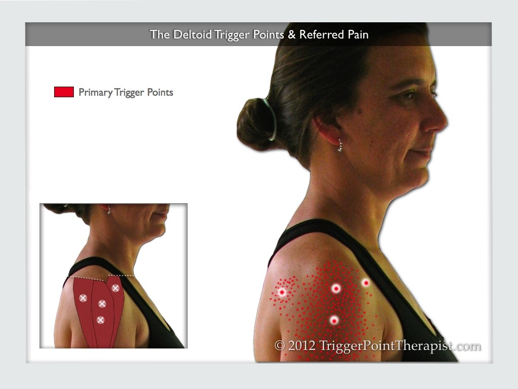 Image of The Deltoid Trigger Points & Referred Pain