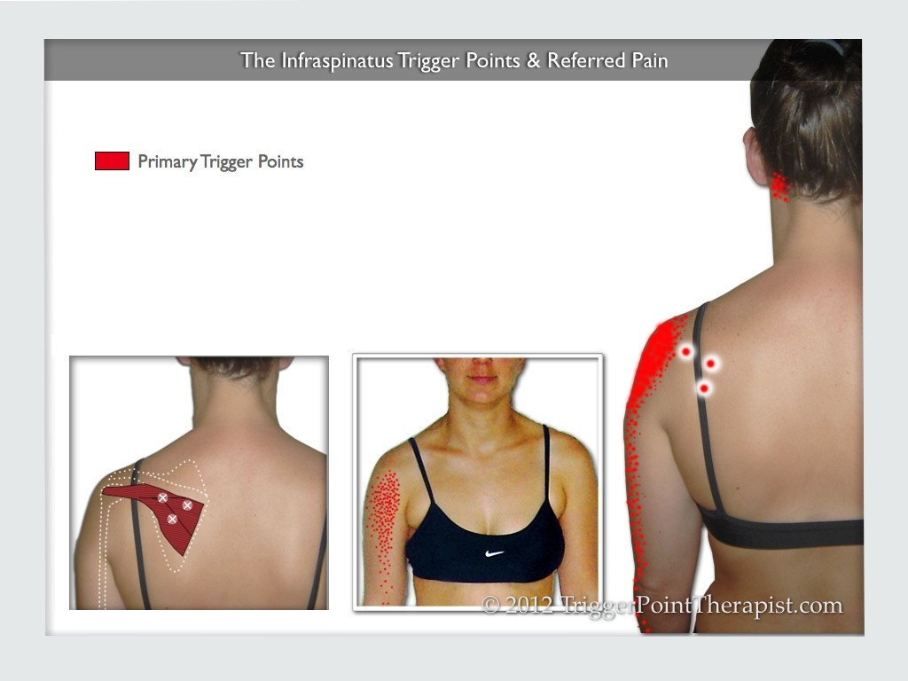 The Infraspinatus Trigger Points & Referred Pain