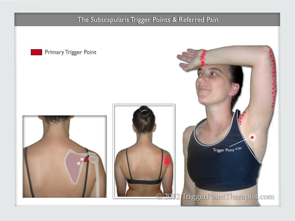Image of The Subscapularis Trigger Points & Referred Pain
