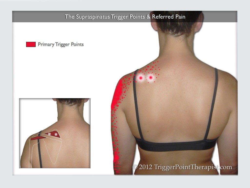 Image of The Supraspinatus Trigger Points & Referred Pain