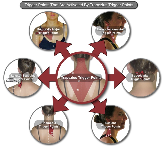 Trapezius muscle pain & trigger points