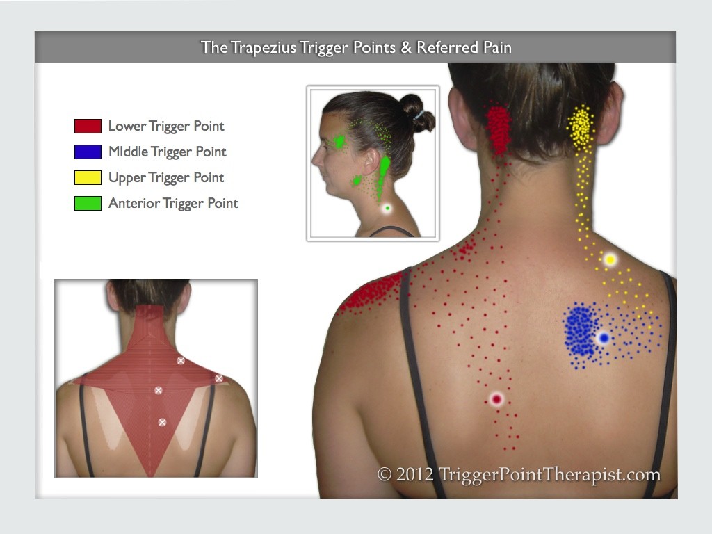 Trigger point in the upper back  Pain at the side of the neck