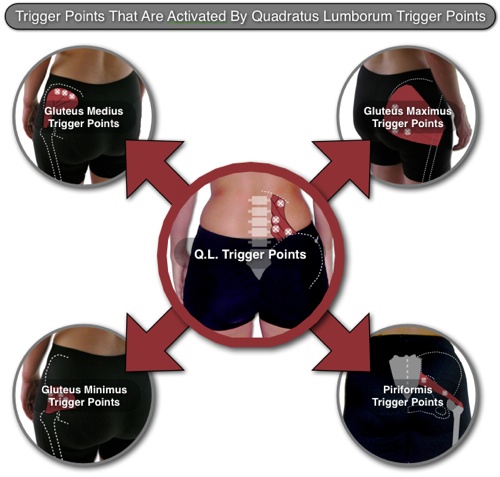 Diagram of "Quadratus Lumborum Trigger Point Interactions"