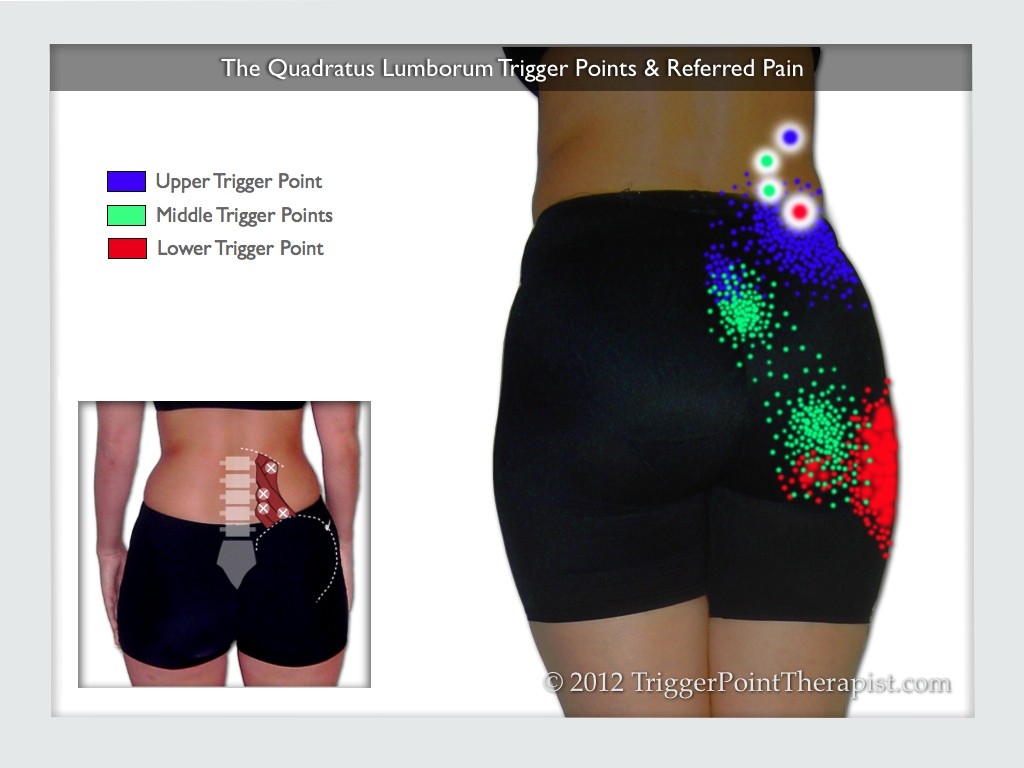 Image for Quadratus Lumborum Trigger Points and Referred Pain