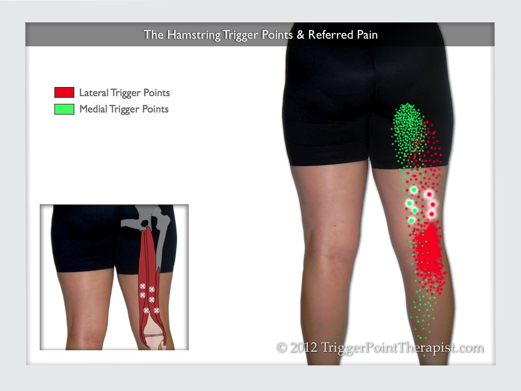 A diagram showing the hamstring trigger points and their referred pain