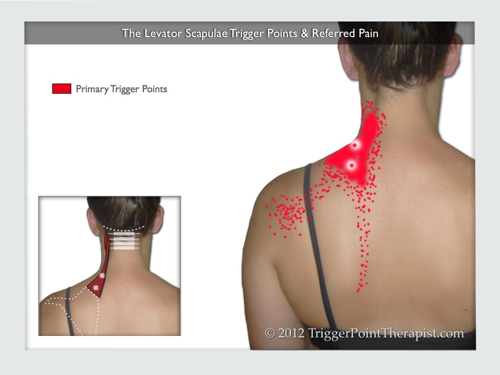 Diagram of the Levator Scapula Trigger Points and Referred Pain