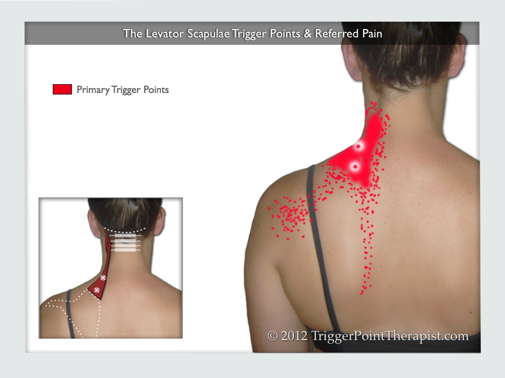 Levator Scapulae Trigger Points Frankenstein Pain