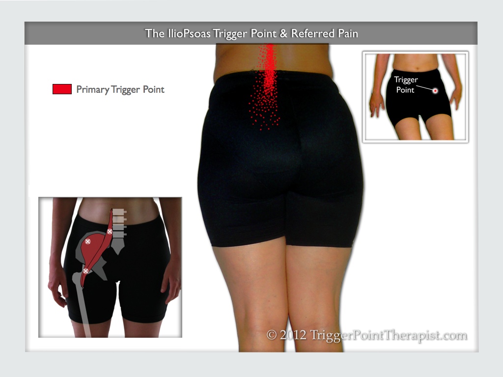  A diagram of the IlioPsoas trigger point and it's referred pain