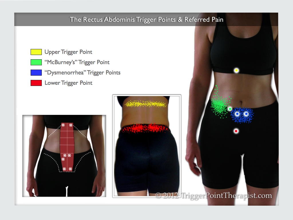 A diagram showing the rectus abdominis trigger points and their referred pain