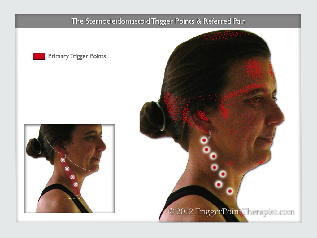 Sternocleidomastoid Trigger Points: Master of the Migraine