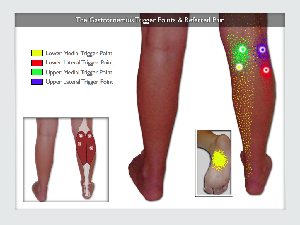 Gastrocnemius Trigger Points The Calf Cramp Trigger Points regarding Cycling Knee Pain Outside