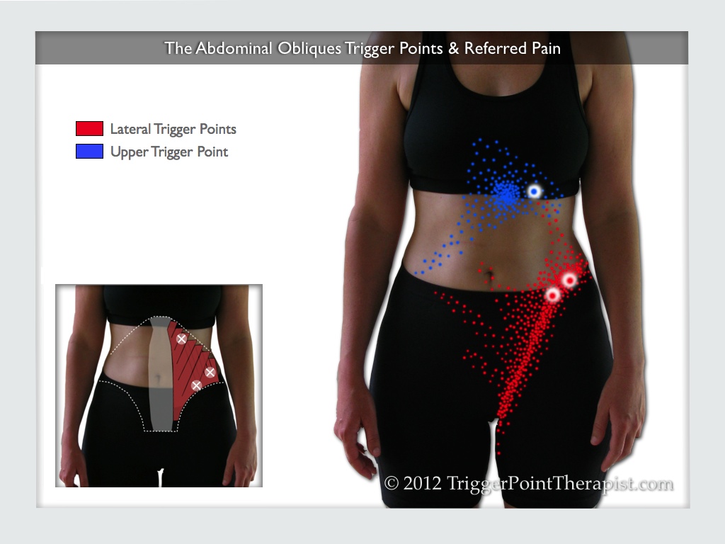 A diagram of the abdominal oblique trigger points and their referred pain