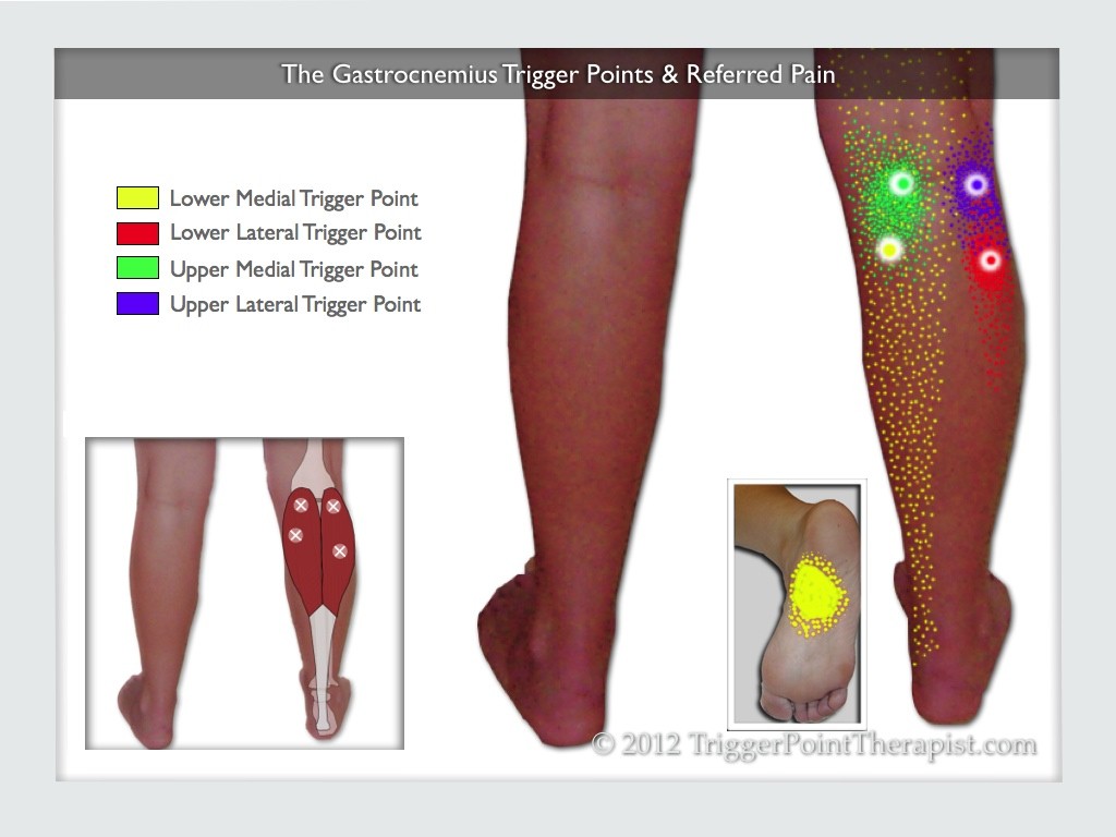 Gastrocnemius Trigger Points and Referred Pain