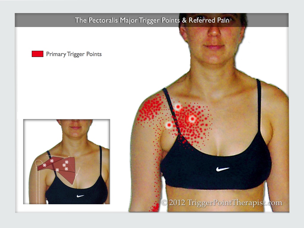 The Pectoralis Major Trigger Points and Referred Pain