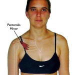 Pectoralis Minor Trigger Point: The Annoying Little Brother