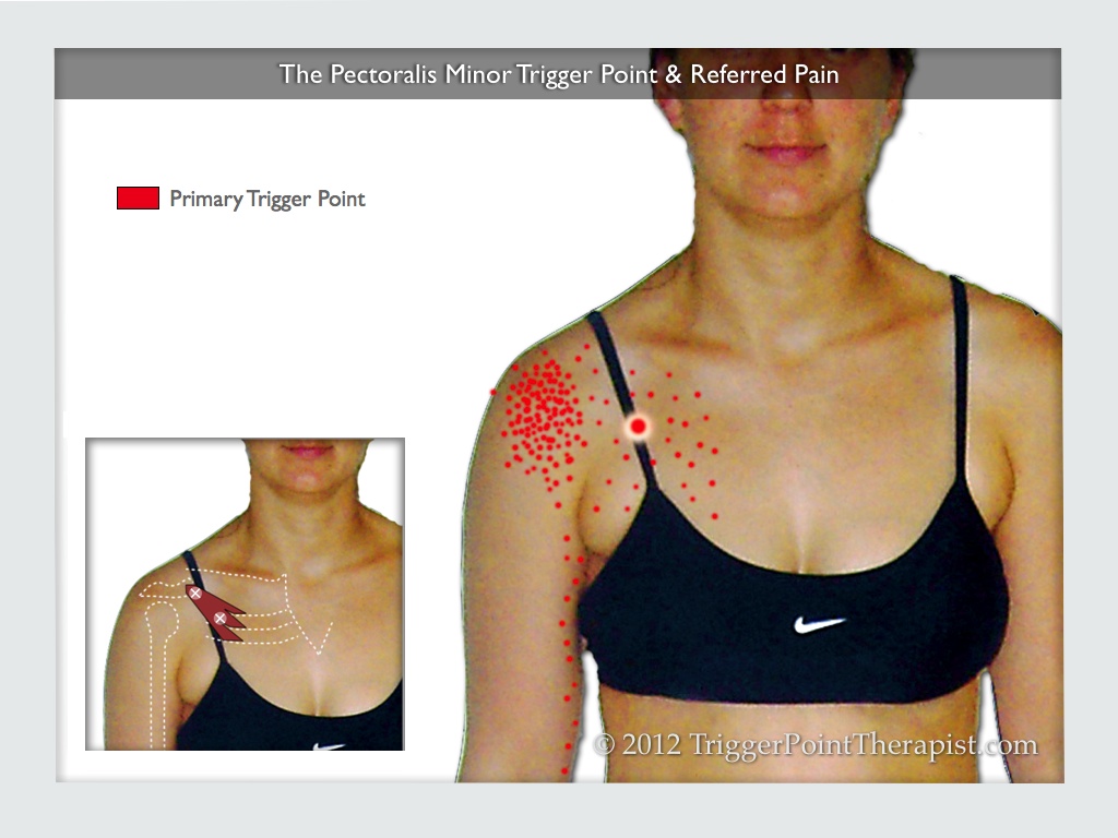 Pec Minor Trigger Point