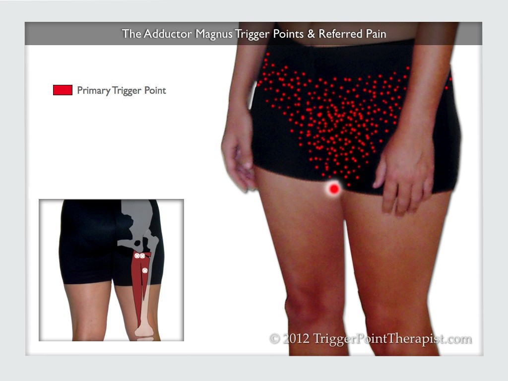 The Adductor Magnus Trigger Points