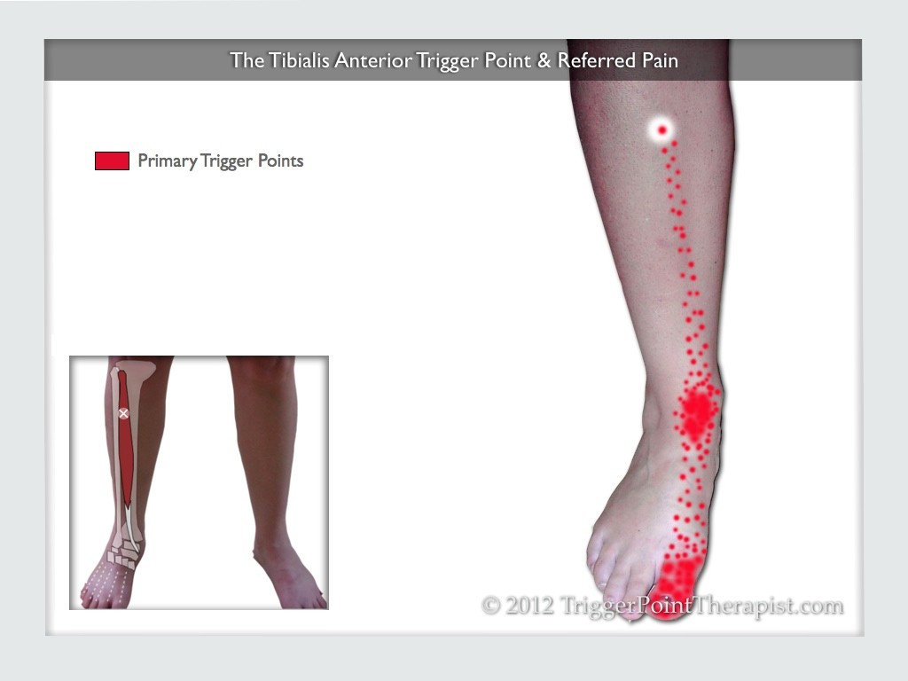 Tibialis Anterior Trigger Point