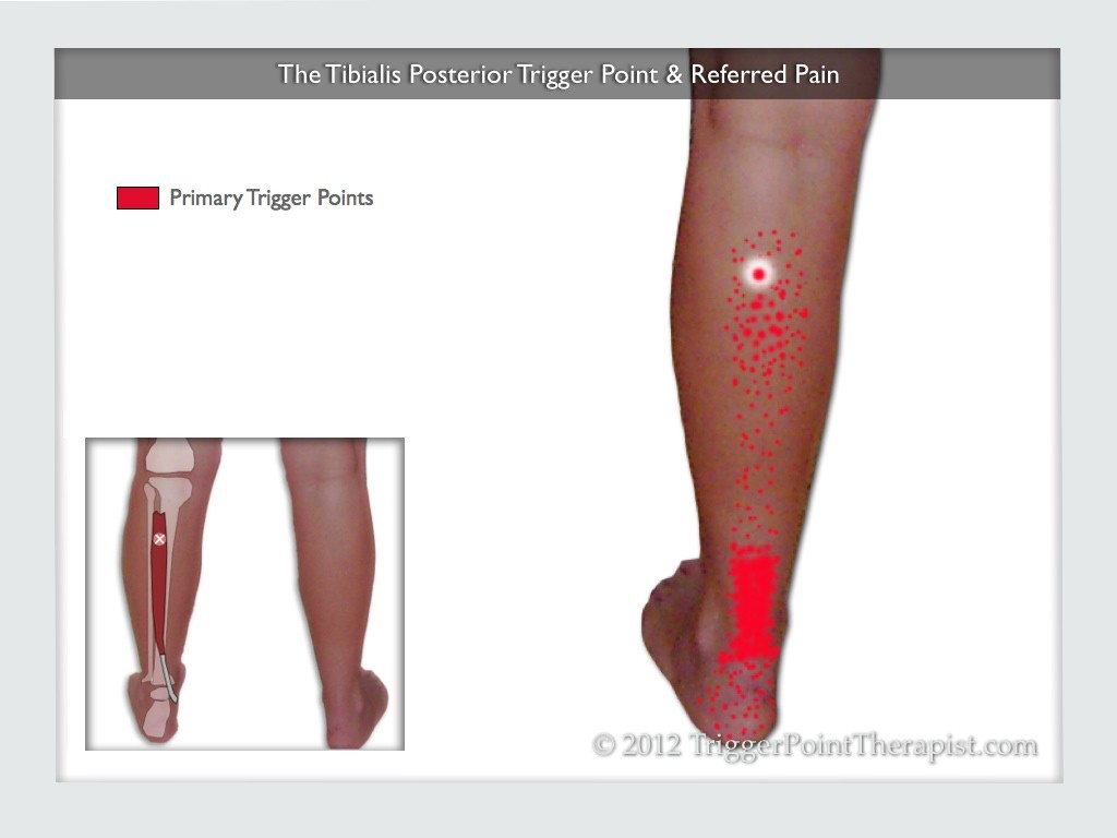 Tibialis Posterior Trigger Point