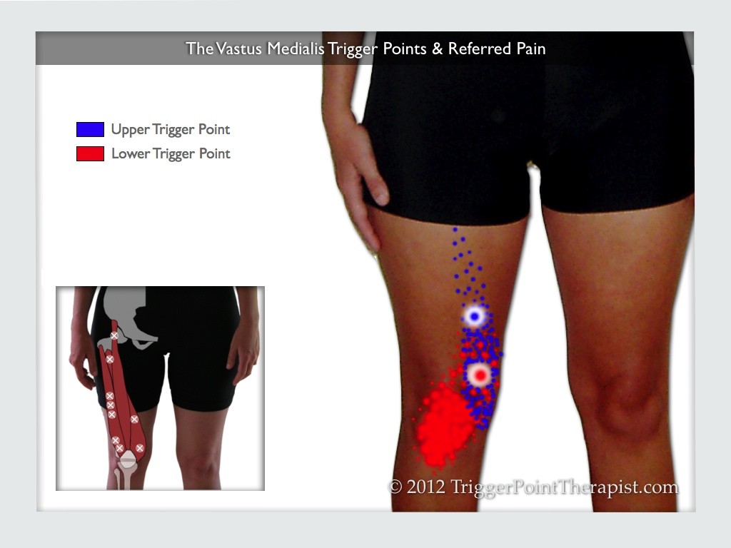 Vastus Medialis Trigger Points The Knee Pain Trigger Points