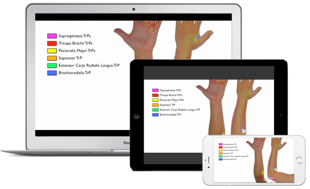 Image for Trigger Point Video Download for Elbow Pain