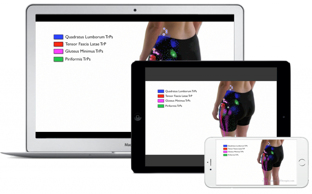 Image of Trigger Point Video Download for Hip Pain