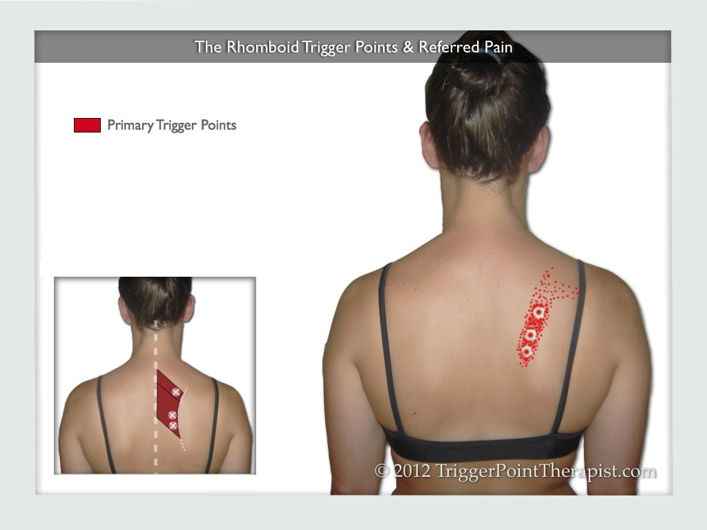 The Rhomboid Trigger Points and Referred Pain