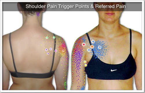 Shoulder Pain Trigger Points: The Multi-Headed Myofascial Pain Monster